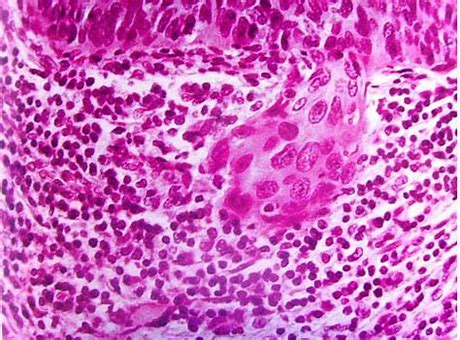 上海关于宫颈癌疫苗的最新报道 